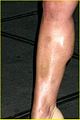 jessica simpson bruised leg 03