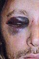 gabriel aubry black eye bloody face revealed 05