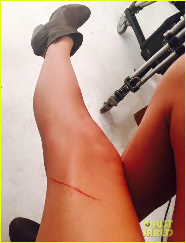 taylor swift cat scratches insured legs 01