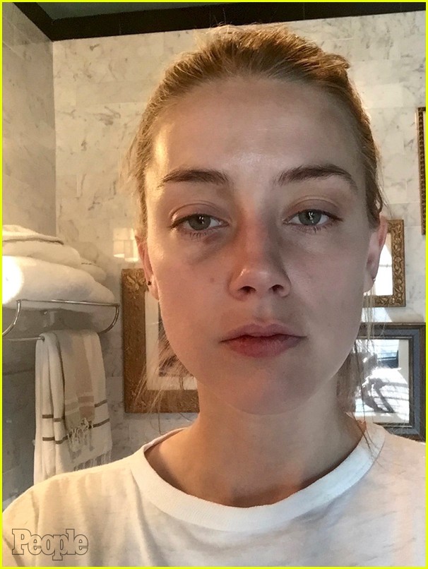 Amber Heard's Injuries Seen in New Photos, Allegedly From Johnny Depp(02)