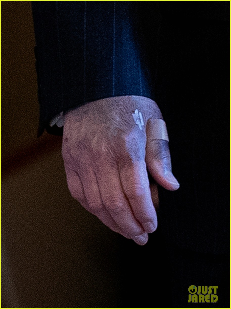 mitch mcconnell on bruised hands 054494899