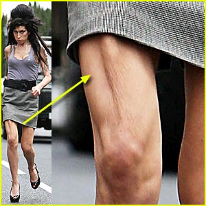 Amy Winehouse Has a Wonky Leg