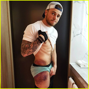 Olympian Gus Kenworthy Pulls His Pants Down to Show His Massive Bruise