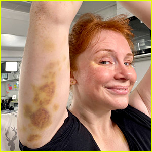 Bryce Dallas Howard Shows Off Her Massive Bruises from 'Jurassic World' Set