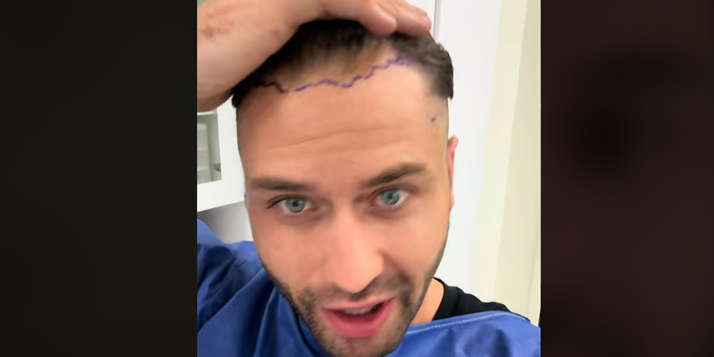 ‘Mormon Wives’ Star Dakota Mortensen Reveals Hair Transplant Journey