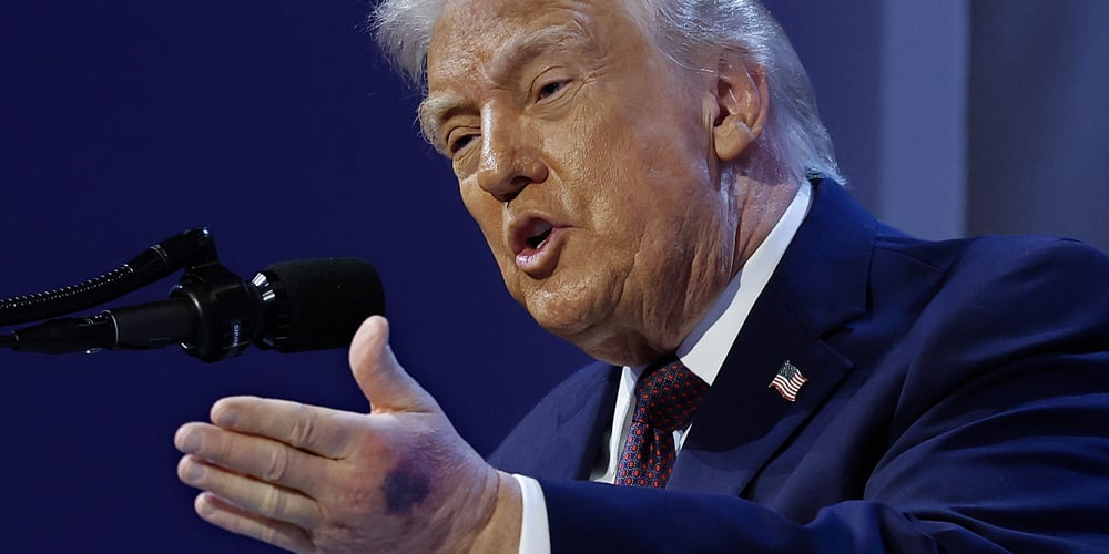 Donald Trump visto com hematomas na mão. A Casa Branca revela o que aconteceu Donald Trump, Política | Notícias e fofocas sobre celebridades | Entretenimento, fotos e vídeos