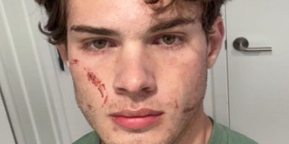 Clavicular Speaks Out After Suspected Overdose, Says ‘That Was Brutal’