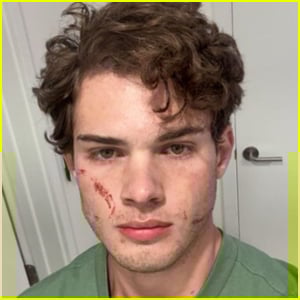 Clavicular Speaks Out After Suspected Overdose, Says 'That Was Brutal'